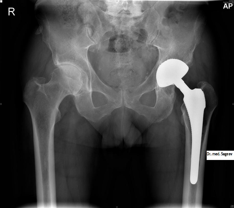 эндопротез